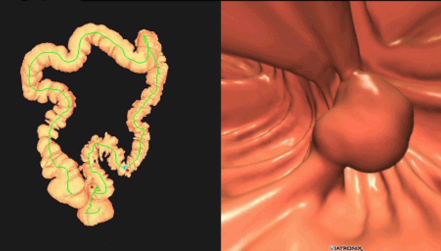 Left shows image of the colon with a red line showing view path and a red dot showing current view location; on the right is the image of a polyp seen at the location of the red dot