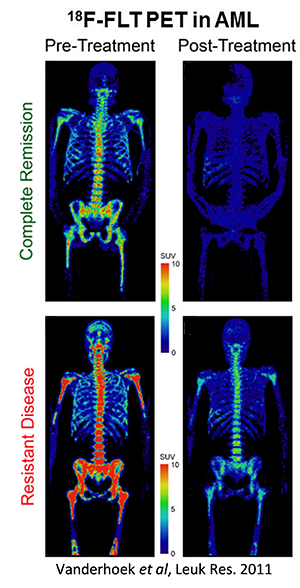 Image from Vanderhoek et al, Leuk Res. 2011, showing 18-F-FLT PET in AML. Image contains 4 full body scans in a grid divided by pre- vs post- treatment and complete remission vs resistant disease. Upper right complete remission, post-treatment scan is clear. Upper left pre-treatment shows many areas in the 5 range on a 0-10 SUV scale. Lower left resistant disease pre-treatment shows many areas at a 10. Lower right resistant disease post-treatment shows some areas around a 4 range.