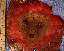 multiple antenna microwave on liver lesion