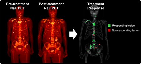Image shows 3 full body scans. First two are pre- and post-treatment NaF PET. The third is a differential composite of the first two, which highlights responding and non-responding lesions. Most lesions show as green, or responding.