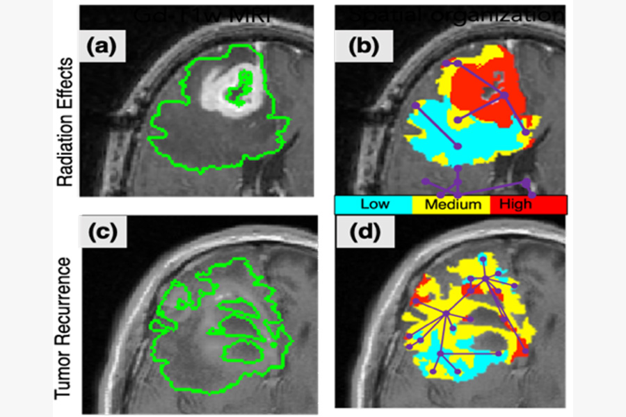 Pallavi Tiwari Awarded $3.4M NIH/NCI grant to study use of AI to detect tumor extent in Glioblastoma