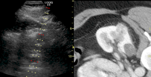 Ultrasound guided biopsy of a solid renal mass.