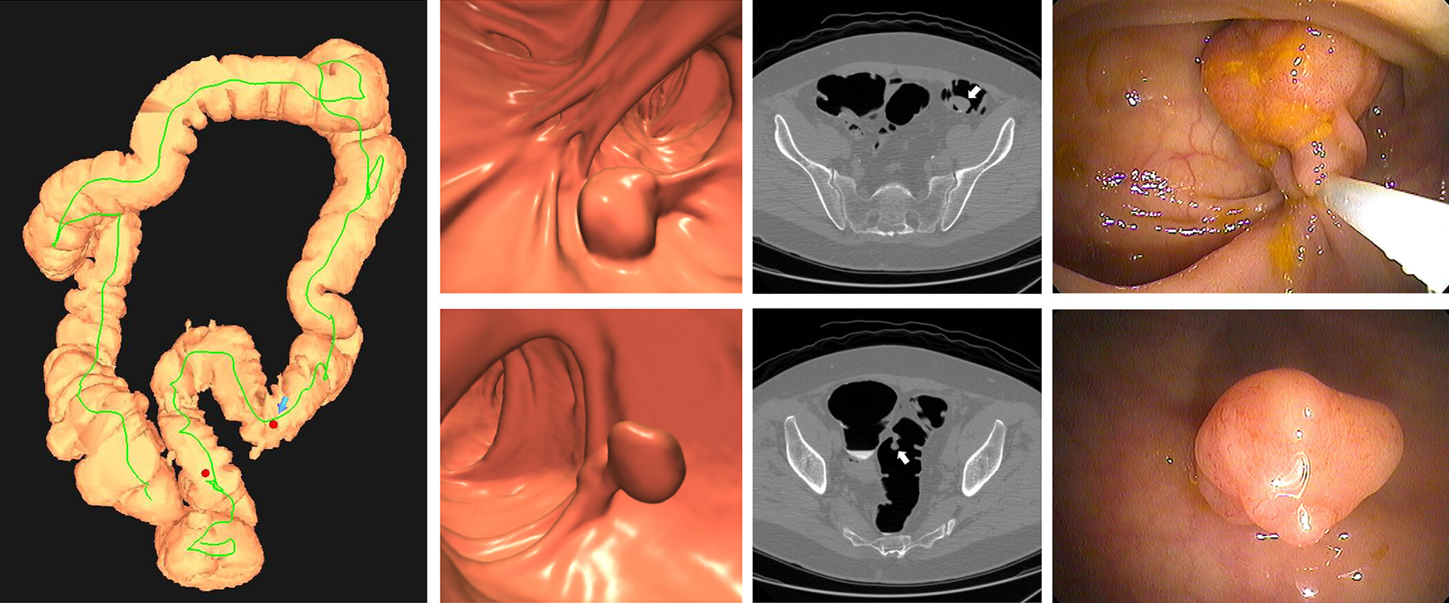 A group of seven images. On the left, three images show a three-dimensional rendering of the colon, produced as part of the CTC screening exam. In the middle, two of the CT images highlight the polyps identified during the screening. On the right, two images from a scope confirm the location of the polyps.
